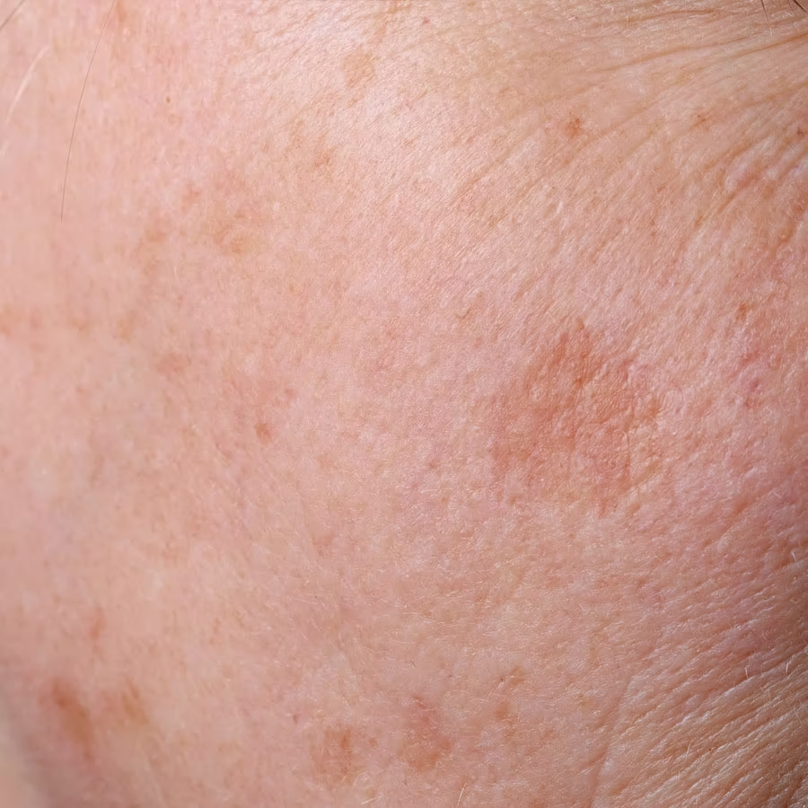 Pigmentflecken Behandlung